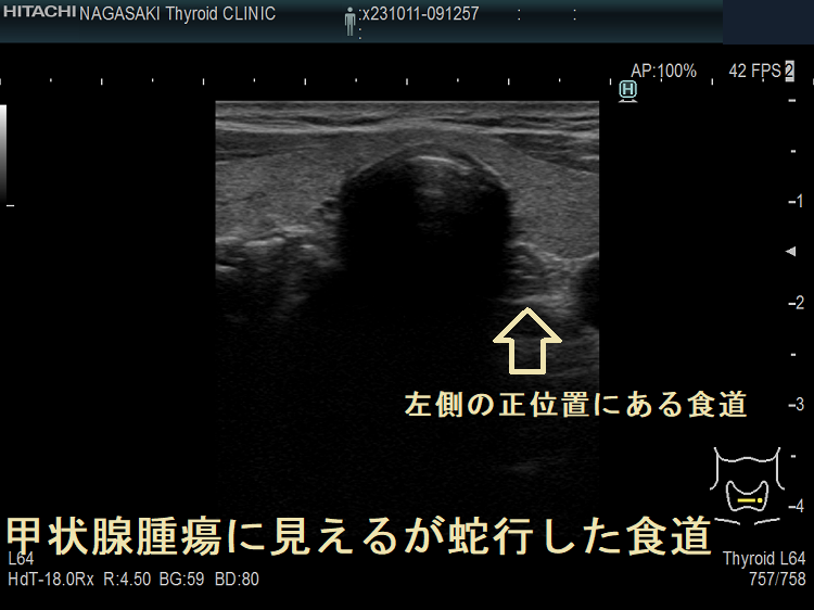 甲状腺腫瘍に見えるが蛇行した食道4 甲状腺腫瘍に見えるが蛇行した食道4
