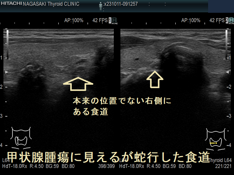 甲状腺腫瘍に見えるが蛇行した食道1 甲状腺腫瘍に見えるが蛇行した食道1