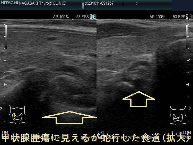 甲状腺腫瘍に見えるが蛇行した食道(拡大)2 甲状腺腫瘍に見えるが蛇行した食道(拡大)2
