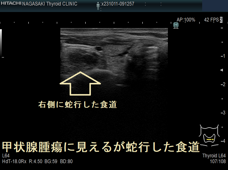 甲状腺腫瘍に見えるが蛇行した食道5 甲状腺腫瘍に見えるが蛇行した食道5