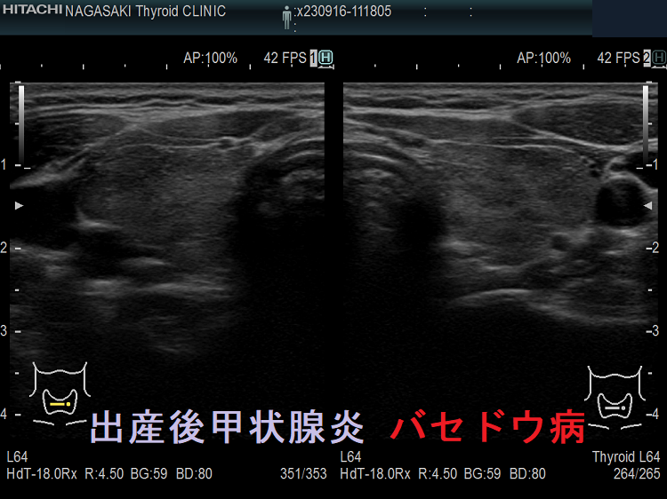出産後甲状腺炎 バセドウ病 出産後甲状腺炎 バセドウ病