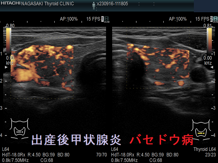 出産後甲状腺炎 バセドウ病 ドプラーモード 出産後甲状腺炎 バセドウ病 ドプラーモード