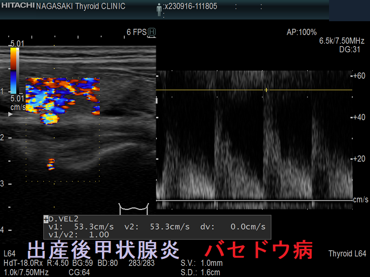 出産後甲状腺炎 バセドウ病 ITA-PSV 出産後甲状腺炎 バセドウ病 ITA-PSV