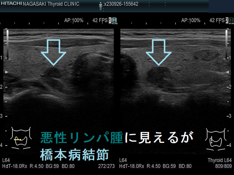 悪性リンパ腫に見えるが橋本病結節 悪性リンパ腫に見えるが橋本病結節