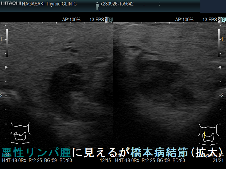悪性リンパ腫に見えるが橋本病結節(拡大) 悪性リンパ腫に見えるが橋本病結節(拡大)