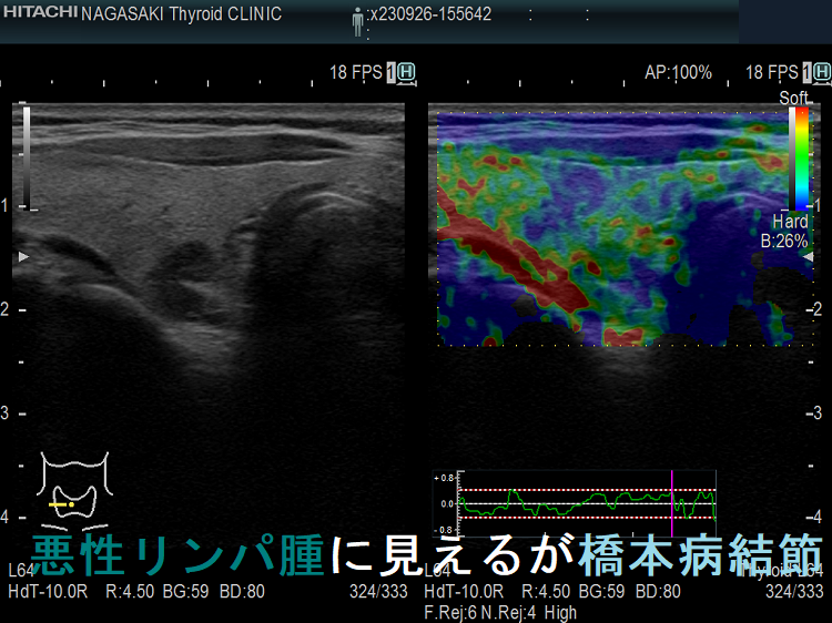 悪性リンパ腫に見えるが橋本病結節 エラストグラフィー 悪性リンパ腫に見えるが橋本病結節 エラストグラフィー