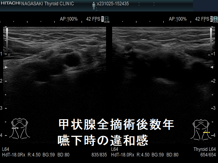 甲状腺全摘術後数年 嚥下時の違和感 甲状腺全摘術後数年 嚥下時の違和感