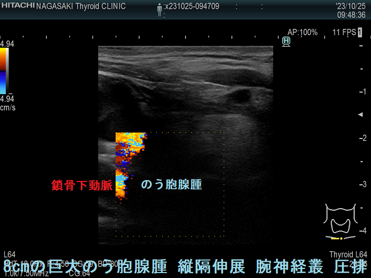 8cmの巨大のう胞腺腫 縦隔伸展 腕神経叢圧排 8cmの巨大のう胞腺腫 縦隔伸展 腕神経叢圧排