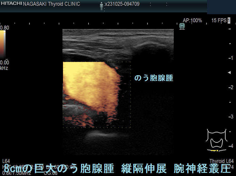 8cmの巨大のう胞腺腫 縦隔伸展 腕神経叢圧排(拡大) 8cmの巨大のう胞腺腫 縦隔伸展 腕神経叢圧排(拡大)