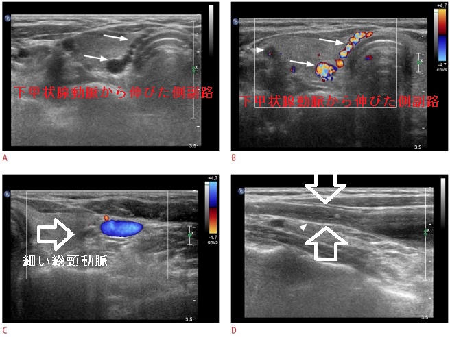 甲状腺超音波エコー検査で見つかった大動脈炎症候群(高安動脈炎) 甲状腺超音波エコー検査で見つかった大動脈炎症候群(高安動脈炎)