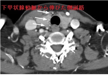 甲状腺超音波エコー検査で見つかった大動脈炎症候群(高安動脈炎) 造影CT画像 甲状腺超音波エコー検査で見つかった大動脈炎症候群(高安動脈炎) 造影CT画像