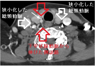 甲状腺超音波エコー検査で見つかった大動脈炎症候群(高安動脈炎) 造影CT画像2 甲状腺超音波エコー検査で見つかった大動脈炎症候群(高安動脈炎) 造影CT画像2