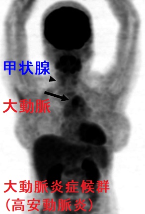大動脈炎症候群(高安動脈炎、脈なし病)と甲状腺の病気の合併 FDG PET/CT 大動脈炎症候群(高安動脈炎、脈なし病)と甲状腺の病気の合併 FDG PET/CT