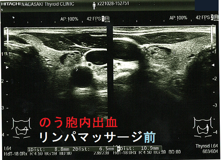 のう胞型腺腫様結節 のう胞内出血 リンパマッサージ前 のう胞型腺腫様結節 のう胞内出血 リンパマッサージ前