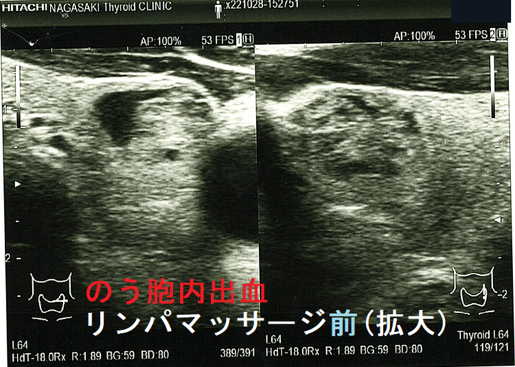 のう胞型腺腫様結節 のう胞内出血 リンパマッサージ前(拡大) のう胞型腺腫様結節 のう胞内出血 リンパマッサージ前(拡大)