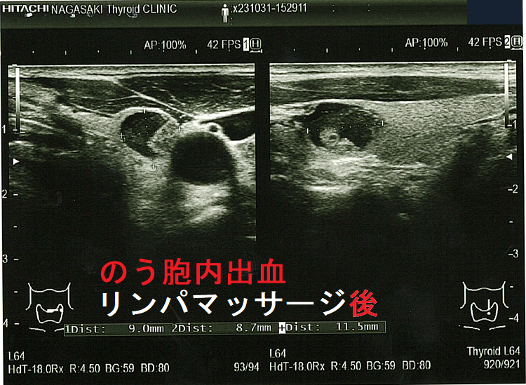 のう胞型腺腫様結節 のう胞内出血 リンパマッサージ後 のう胞型腺腫様結節 のう胞内出血 リンパマッサージ後