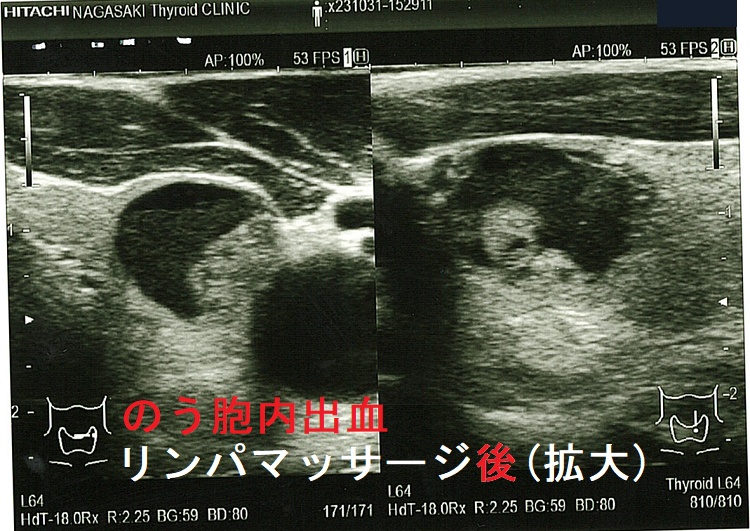のう胞型腺腫様結節 のう胞内出血 リンパマッサージ後(拡大) のう胞型腺腫様結節 のう胞内出血 リンパマッサージ後(拡大)