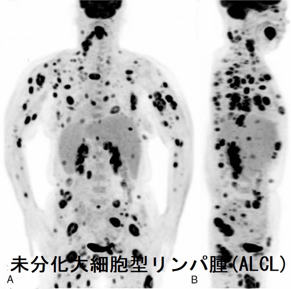 未分化大細胞型リンパ腫(ALCL) PET画像 未分化大細胞型リンパ腫(ALCL) PET画像