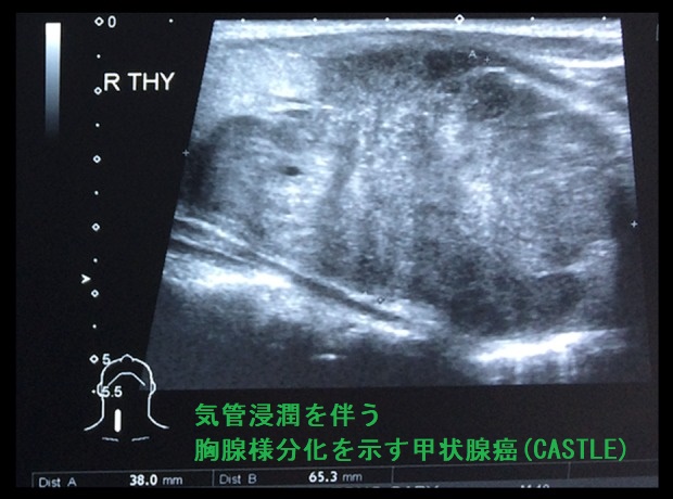 気管浸潤を伴う胸腺様分化を示す甲状腺癌(CASTLE)超音波(エコー)画像 気管浸潤を伴う胸腺様分化を示す甲状腺癌(CASTLE)超音波(エコー)画像