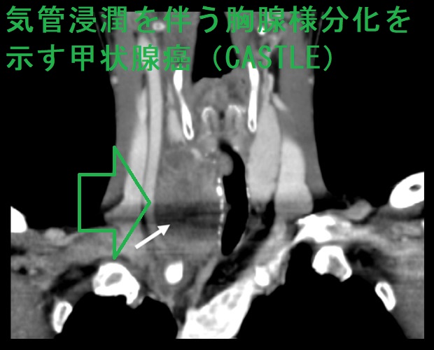 気管浸潤を伴う胸腺様分化を示す甲状腺癌(CASTLE)CT画像 気管浸潤を伴う胸腺様分化を示す甲状腺癌(CASTLE)CT画像
