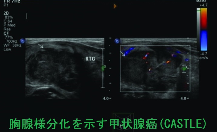 胸腺様分化を示す甲状腺癌(CASTLE)超音波(エコー)画像 胸腺様分化を示す甲状腺癌(CASTLE)超音波(エコー)画像2
