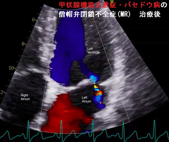甲状腺機能亢進症・バセドウ病の僧帽弁閉鎖不全症(MR) 治療後 甲状腺機能亢進症・バセドウ病の僧帽弁閉鎖不全症(MR) 治療後