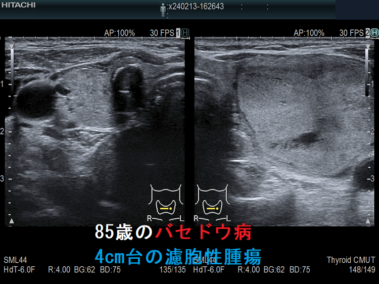 85歳のバセドウ病、4cm台の濾胞性腫瘍 全体像 85歳のバセドウ病、4cm台の濾胞性腫瘍 全体像