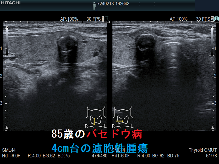 85歳のバセドウ病、4cm台の濾胞性腫瘍 右葉 85歳のバセドウ病、4cm台の濾胞性腫瘍 右葉