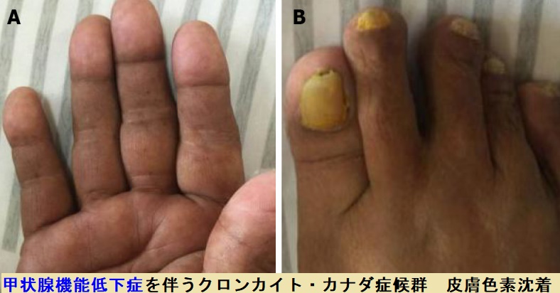 甲状腺機能低下症を伴うクロンカイト・カナダ症候群 皮膚色素沈着 甲状腺機能低下症を伴うクロンカイト・カナダ症候群 皮膚色素沈着