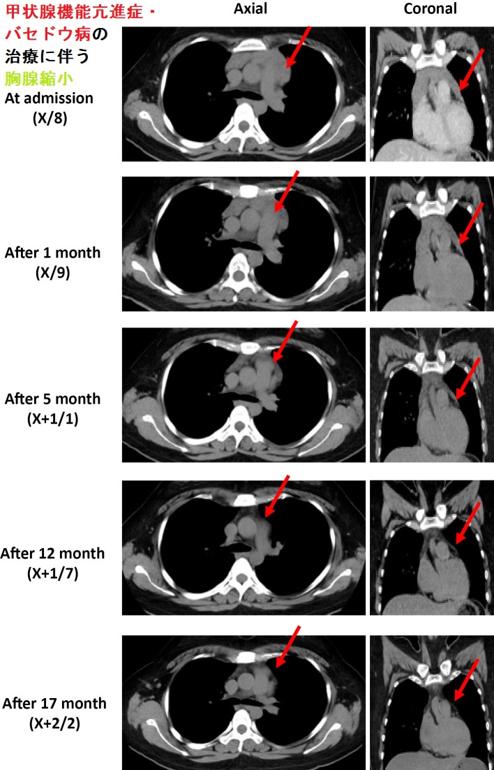 甲状腺機能亢進症・バセドウ病の治療に伴う胸腺の縮小 甲状腺機能亢進症・バセドウ病の治療に伴う胸腺の縮小
