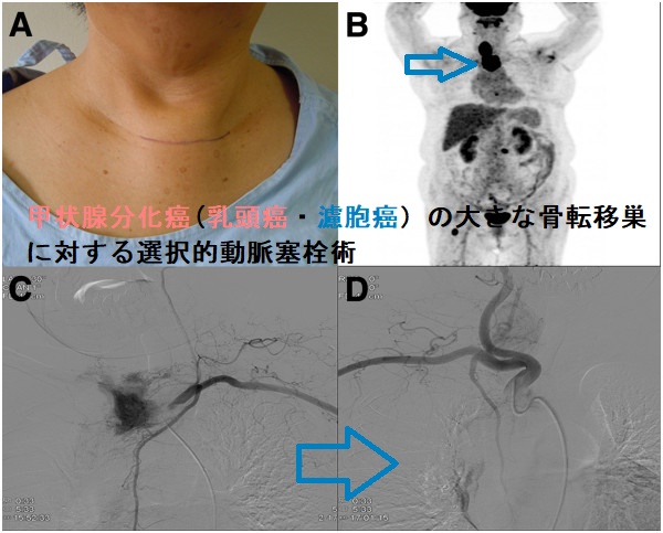 甲状腺分化癌(乳頭癌・濾胞癌)の大きな骨転移巣に対する選択的動脈塞栓術 甲状腺分化癌(乳頭癌・濾胞癌)の大きな骨転移巣に対する選択的動脈塞栓術
