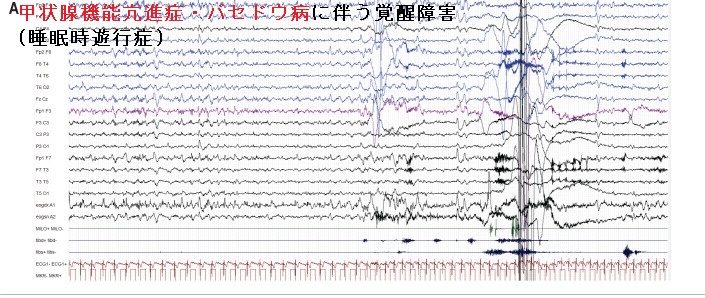 甲状腺機能亢進症・バセドウ病に伴う覚醒障害(睡眠時遊行症) 甲状腺機能亢進症・バセドウ病に伴う覚醒障害(睡眠時遊行症)