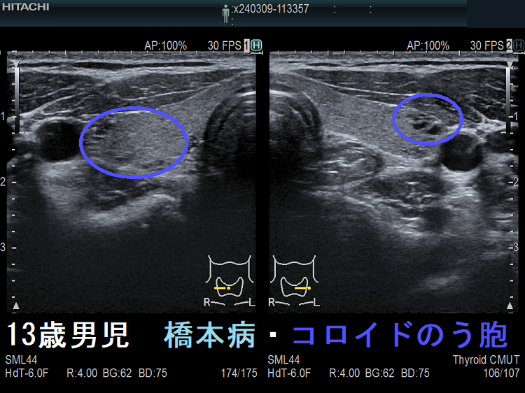 甲状腺・頚部の超音波診断 甲状腺・頚部の超音波診断 | 岩田政広, 笠木寛治, 河合直之 |本