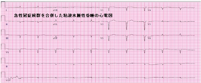 急性冠症候群を合併した粘液水腫性昏睡の心電図 急性冠症候群を合併した粘液水腫性昏睡の心電図