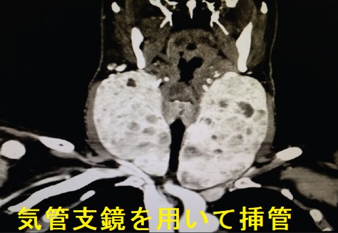 気管支鏡を用いて挿管 CT画像 気管支鏡を用いて挿管 CT画像
