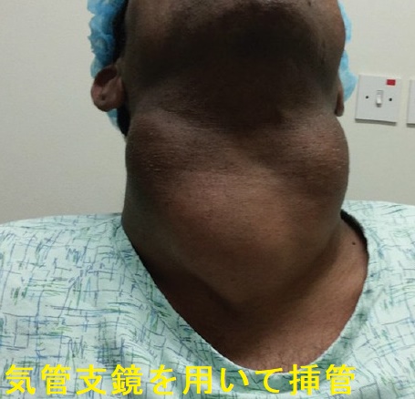 気管支鏡を用いて挿管 気管支鏡を用いて挿管