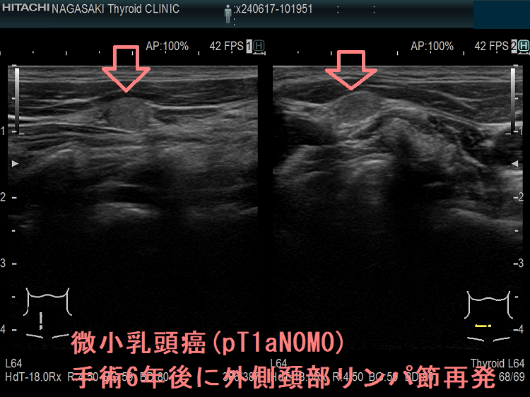pT1aN0M0微小乳頭癌手術6年後に外側頚部リンパ節再発 pT1aN0M0微小乳頭癌手術6年後に外側頚部リンパ節再発
