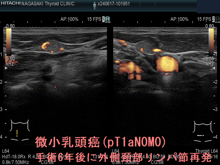 pT1aN0M0微小乳頭癌手術6年後に外側頚部リンパ節再発 ドプラーモード pT1aN0M0微小乳頭癌手術6年後に外側頚部リンパ節再発 ドプラーモード