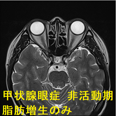 甲状腺眼症 非活動期 脂肪増生のみ 甲状腺眼症 非活動期 脂肪増生のみ