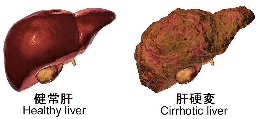 肝硬変　画像 