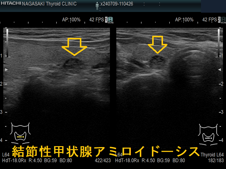甲状腺アミロイドーシス・結節性甲状腺アミロイドーシス[橋本病