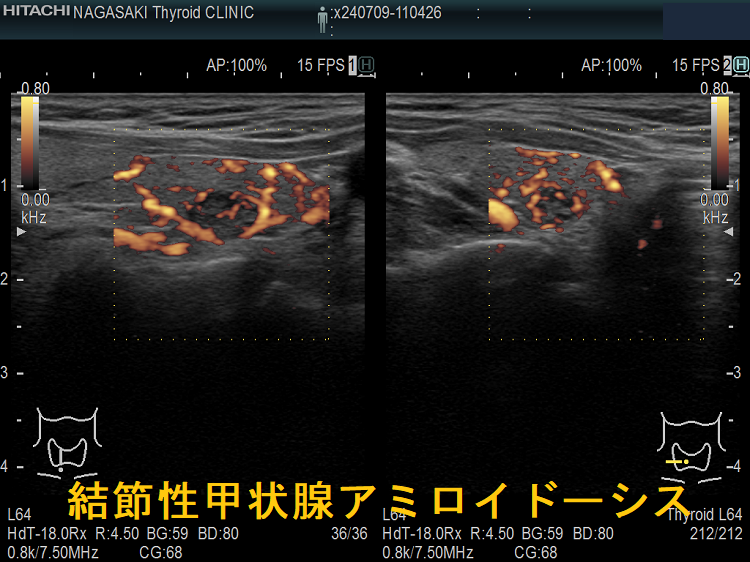結節性甲状腺アミロイドーシス ドプラーモード 結節性甲状腺アミロイドーシス ドプラーモード