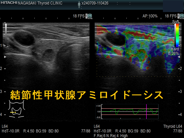 甲状腺アミロイドーシス・結節性甲状腺アミロイドーシス[橋本病