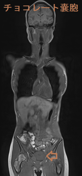 チョコレート嚢胞