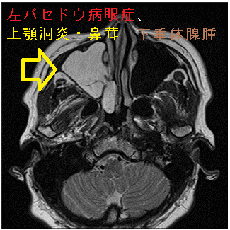 左バセドウ病眼症、上顎洞炎・鼻茸、下垂体腺腫 MRI画像 左バセドウ病眼症、上顎洞炎・鼻茸、下垂体腺腫 MRI画像