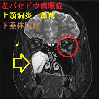 左バセドウ病眼症、上顎洞炎・鼻茸、下垂体腺腫 MRI画像 2 左バセドウ病眼症、上顎洞炎・鼻茸、下垂体腺腫 MRI画像 2