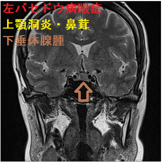 左バセドウ病眼症、下垂体腺腫、上顎洞炎・鼻茸 ダイナミックMRI画像 左バセドウ病眼症、下垂体腺腫、上顎洞炎・鼻茸 ダイナミックMRI画像