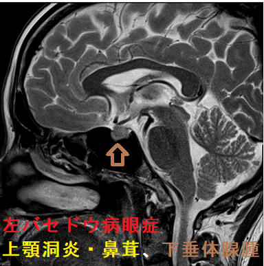 左眼バセドウ病眼症、下垂体腺腫、上顎洞炎・鼻茸 合併 ダイナミックMRI画像 左眼バセドウ病眼症、下垂体腺腫、上顎洞炎・鼻茸 合併 ダイナミックMRI画像