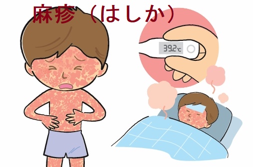 麻疹(はしか) 麻疹(はしか)