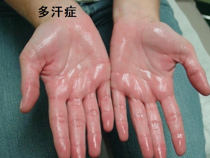 多汗症 手 多汗症 手
